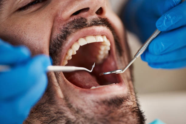 Dental Inlays and Onlays in Crestview Hills, KY